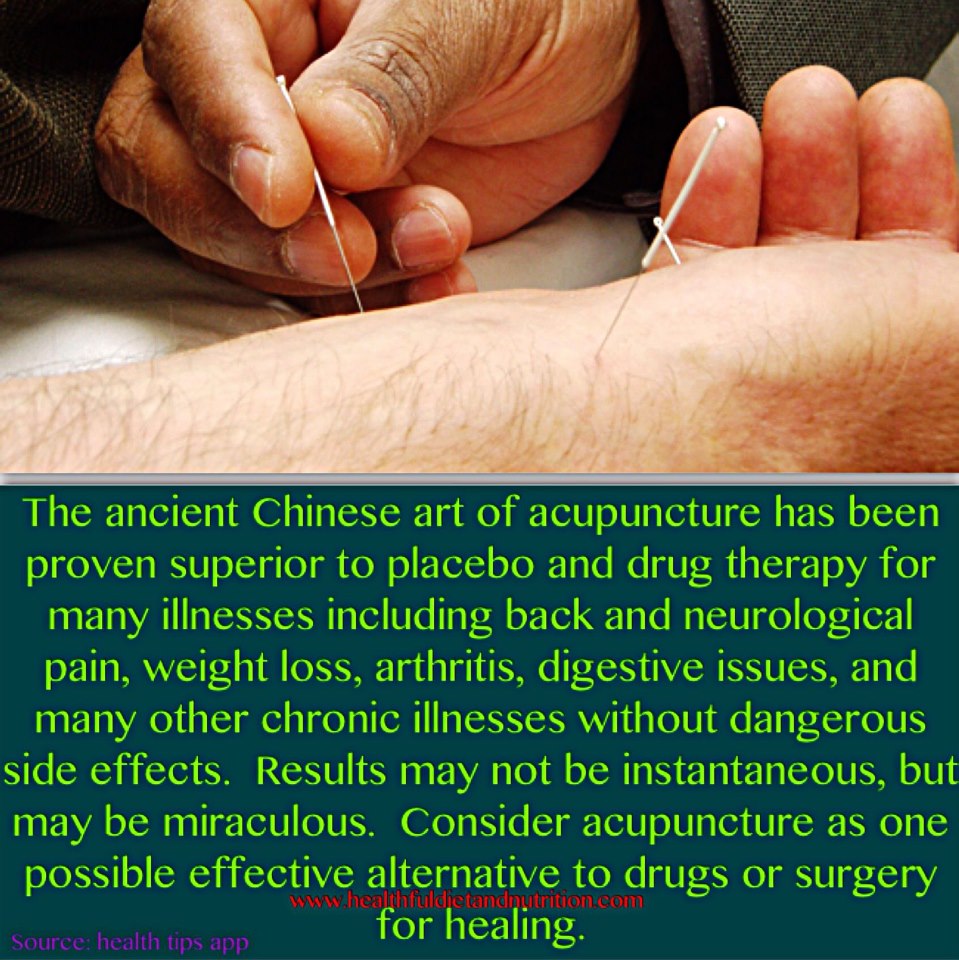Consider Acupuncture