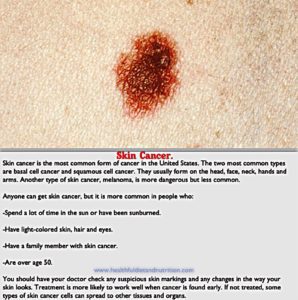 Skin cancer is one of the most common forms of cancer, arising from the abnormal growth of skin cells, often due to excessive UV exposure from the sun or tanning beds. The three main types are basal cell carcinoma (BCC), squamous cell carcinoma (SCC), and melanoma, the latter being the deadliest. Early detection through regular skin checks and monitoring changes in moles or lesions is crucial. Symptoms may include unusual growths, changes in skin color, or sores that do not heal. Prevention strategies include using sunscreen, wearing protective clothing, and avoiding peak sunlight hours. Timely treatment significantly improves outcomes.