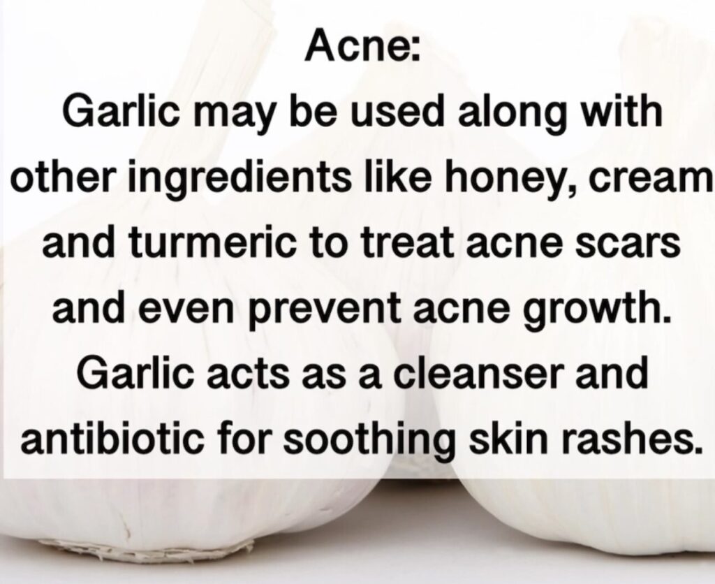 10. Acne: Garlic may be used along with other ingredients like honey, cream and turmeric to treat acne scars and even prevent acne growth. Garlic acts as a cleanser and antibiotic for soothing skin rashes.