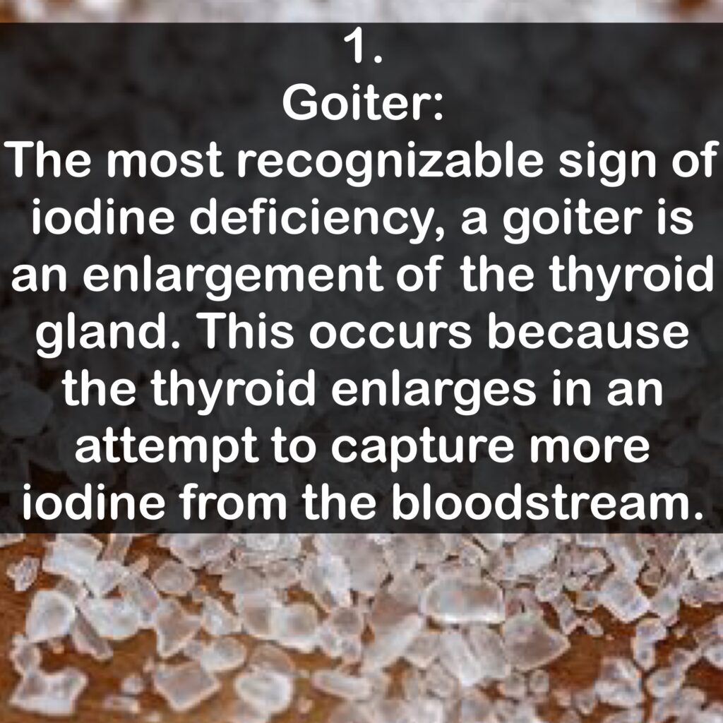 1. Goiter: The most recognizable sign of iodine deficiency, a goiter is an enlargement of the thyroid gland. This occurs because the thyroid enlarges in an attempt to capture more iodine from the bloodstream.