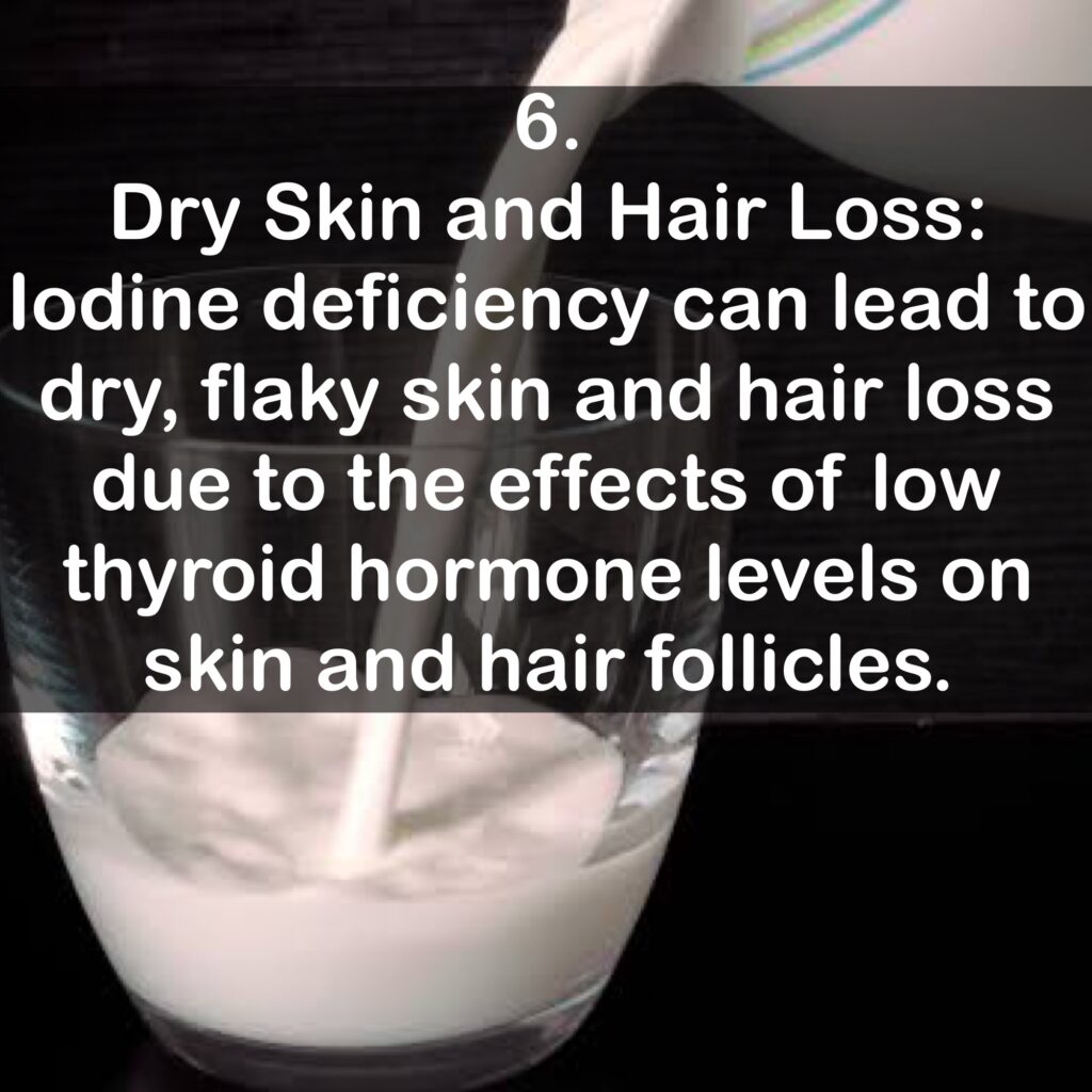 6. Dry Skin and Hair Loss: lodine deficiency can lead to dry, flaky skin and hair loss due to the effects of low thyroid hormone levels on skin and hair follicles.