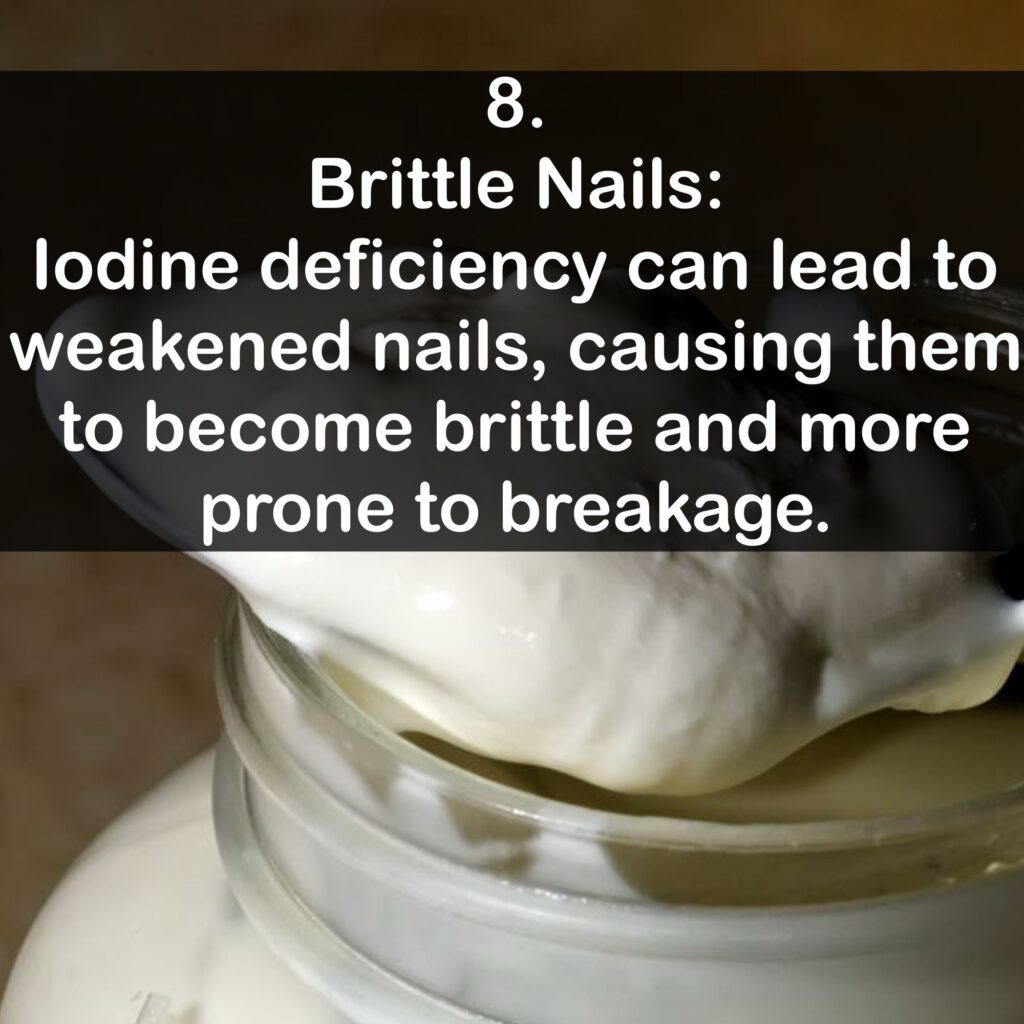 8. Brittle Nails: lodine deficiency can lead to weakened nails, causing them to become brittle and more prone to breakage.