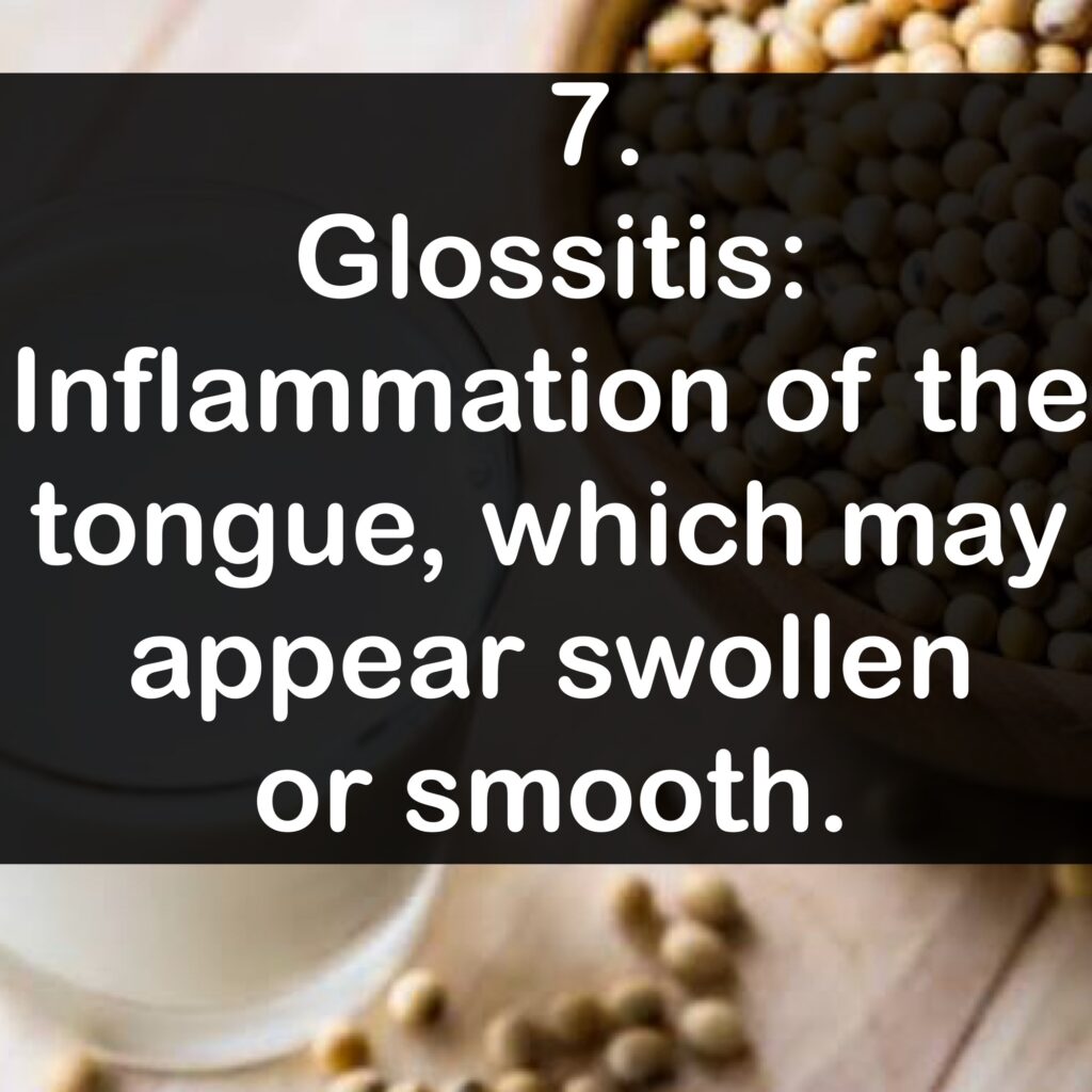 7. Glossitis: Inflammation of the tongue, which may appear swollen or smooth.