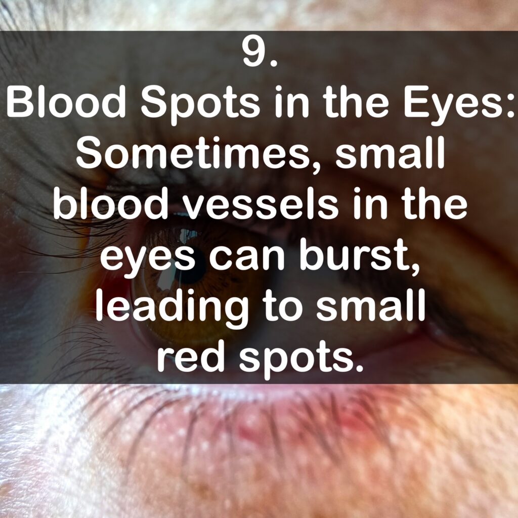 9. Blood Spots in the Eyes: Sometimes, small blood vessels in the eyes can burst, leading to small red spots.