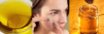 How to Cure Your Acne With a 100% Natural Cleansing Regime