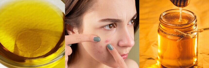 How to Cure Your Acne With a 100% Natural Cleansing Regime