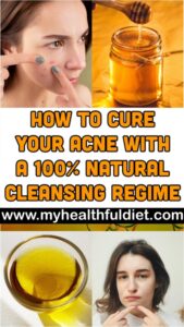 How to Cure Your Acne With a 100% Natural Cleansing Regime