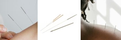 How Does Acupuncture Work?