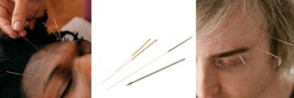 How Acupuncture Can Relieve Your Headache Pains